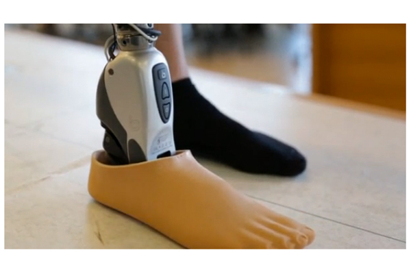 Amputees control Össur bionic legs with their thoughts