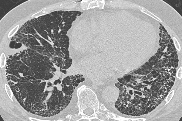 Medicare OKs coverage of high-risk CT lung screening 
