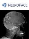 FLASH: FDA approves NeuroPace's anti-epilepsy implant