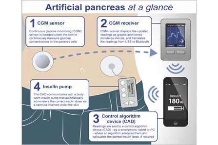 Partnerships pursue artificial pancreas technology
