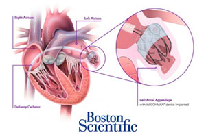 Boston Scientific's Watchman heart implant