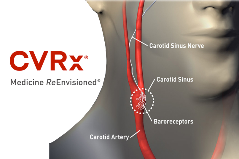 CVRx's Barostim neo gets CE Mark for use with MRIs