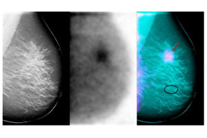 Breast tomosynthesis