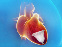 CardioKinetix touts early results with Parachute heart implant