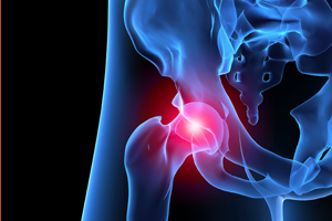 UPDATE: Stryker inks $1B+ deal to settle hip implant cases