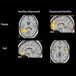 fMRI for depression