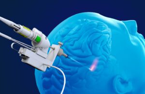 Monteris Medical marketing image of the NeuroBlate robotic surgery system