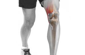Marketing image of the Moximed Misha implantable shock absorber knee osteoarthritis