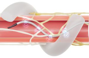 An illustration showing the Medtronic Symplicty Spyral renal denervation (RDN) ablation catheter expanded inside the renal arteries and ablating nerves in the vessel walls to treat hypertension.