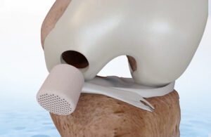 This image from CartiHeal and Smith+Nephew shows the Agili-C is a porous, biocompatible, and resorbable scaffold for cartilage regeneration in the knee.