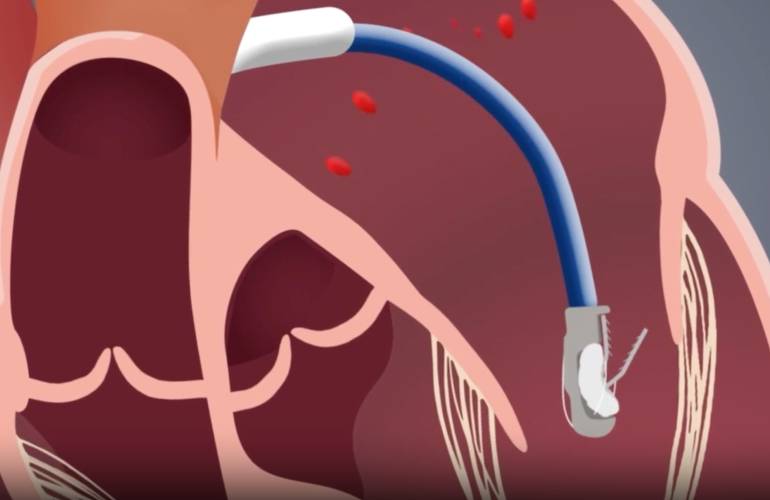 Nyra Medical initiates first-in-human study of heart implant
